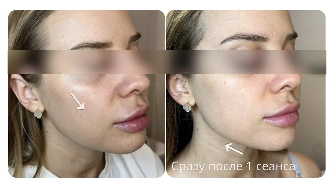 Лицо до и сразу после одного сеанса EMS 3 в 1
